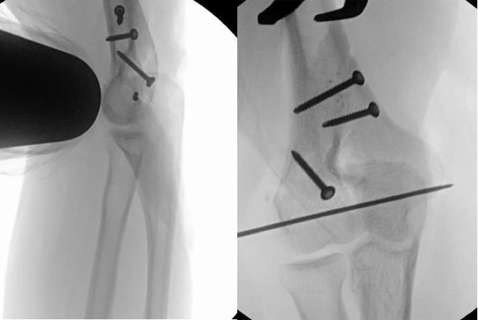 Distal Humerus Fracture Adult Hand Surgery Resource